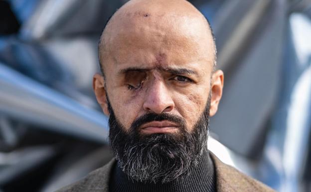 De perder un ojo en el frente a ser el rostro de una marca de moda