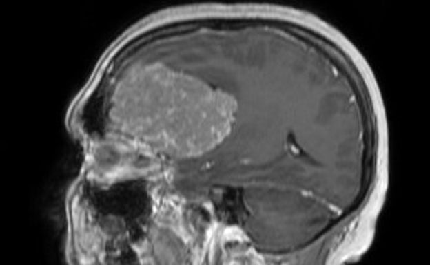 La mujer que dilapidó 200.000 euros en zapatos por un tumor cerebral
